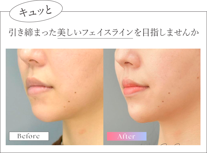 キュッと引き締まった美しいフェイスラインに