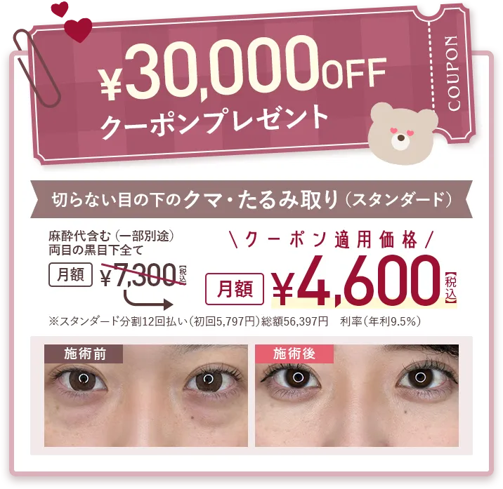 切らない目の下のクマ・たるみ取り 53,600円(税込)~