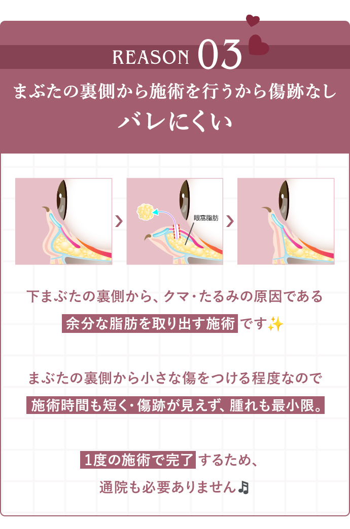 REASON03 まぶたの裏側から施術を行う施術です