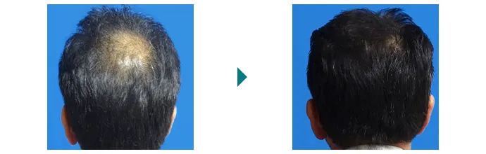 頭頂部の抜け毛・薄毛を改善