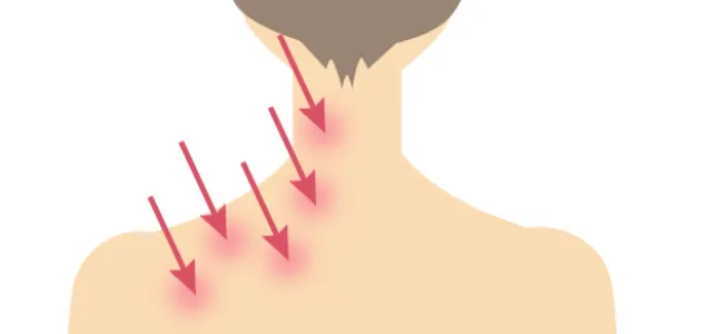 肩のボトックス注射とは？
