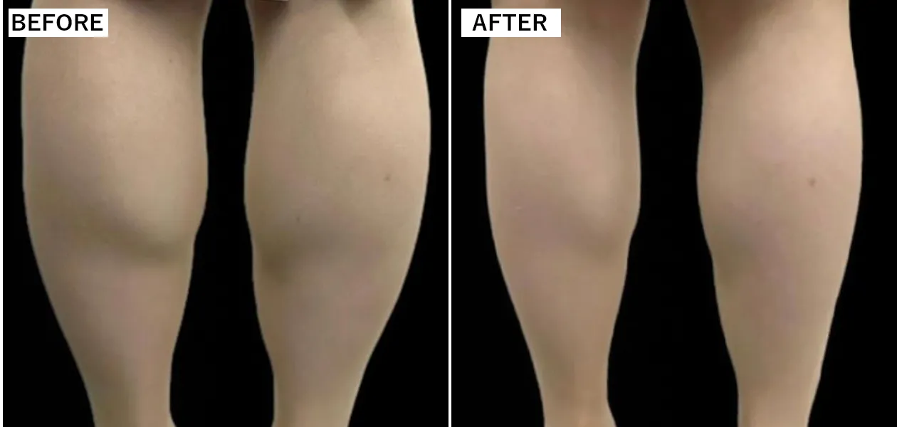 脚痩せ・ふくらはぎ注射・症例