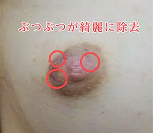症例写真After