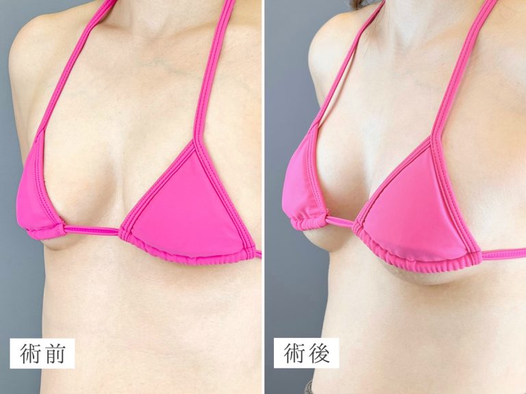 豊胸の症例写真