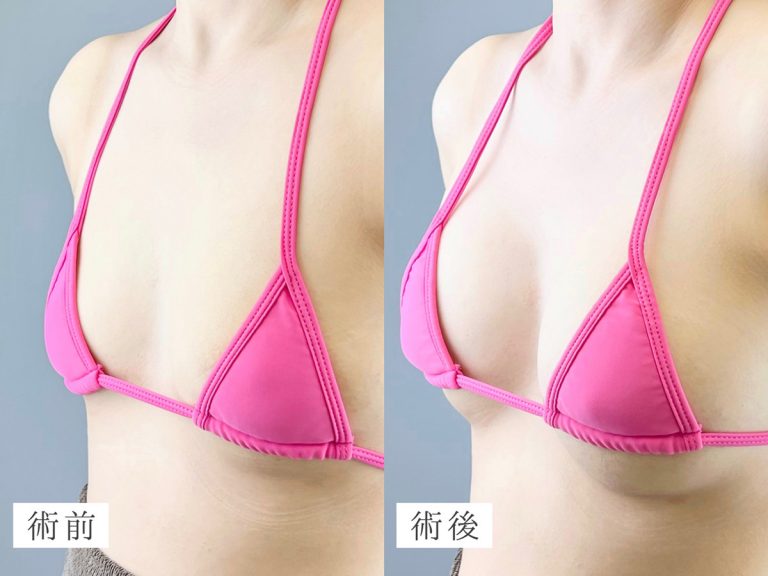 豊胸の症例写真
