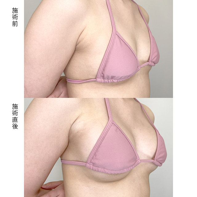 豊胸の症例写真