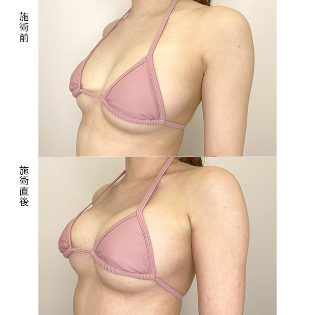 豊胸の症例写真