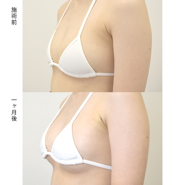 豊胸の症例写真