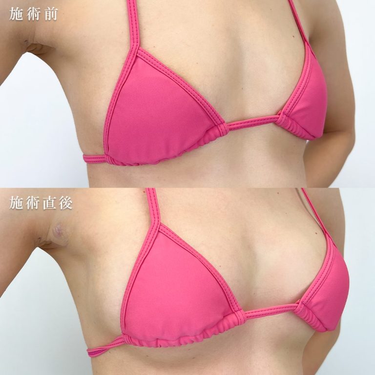 豊胸の症例写真