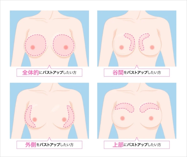 施術図
