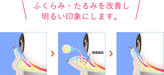 ふくらみ・たるみを改善し、明るい印象にします。