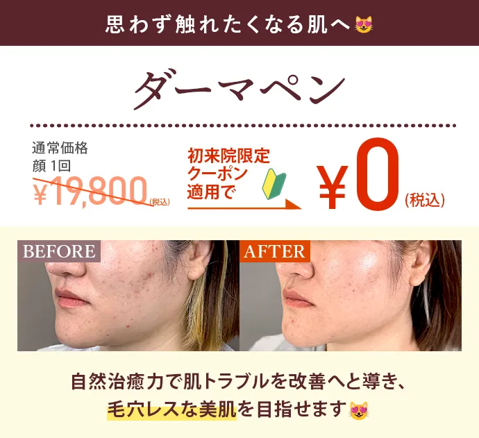 ダーマペン