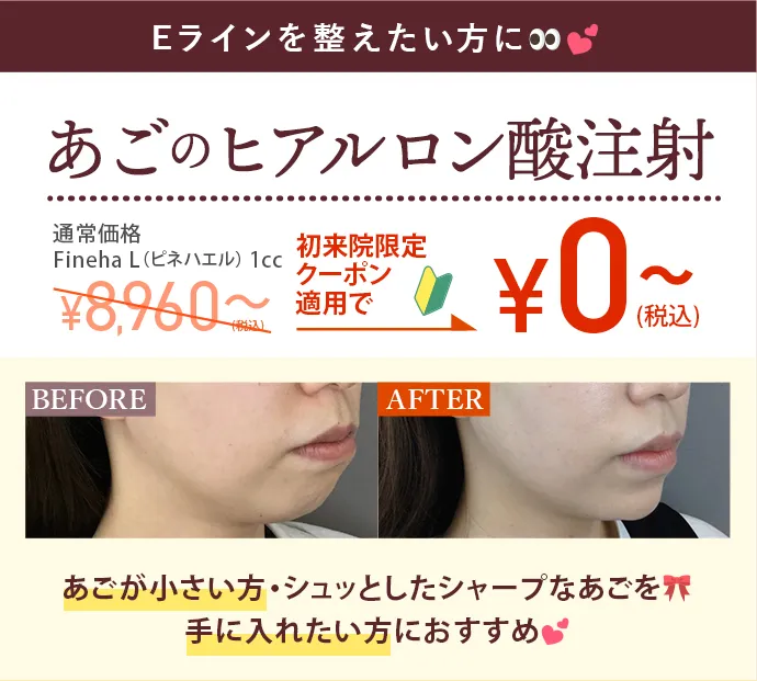 あごのヒアルロン酸注射