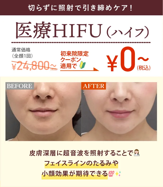 医療HIFU（ハイフ）