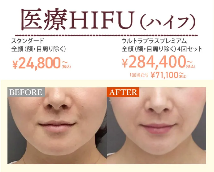 医療HIFU（ハイフ）