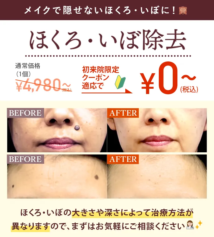 ほくろ・いぼ除去