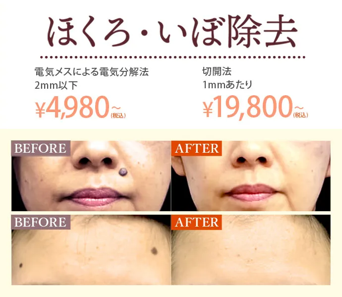 ほくろ・いぼ除去