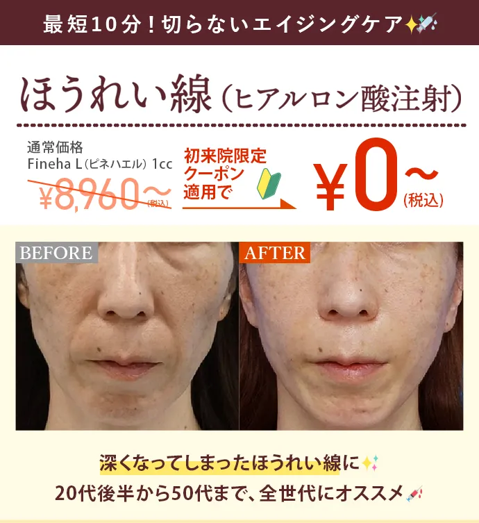 ほうれい線（ヒアルロン酸注射）