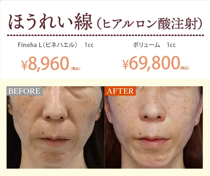 ほうれい線（ヒアルロン酸注射）