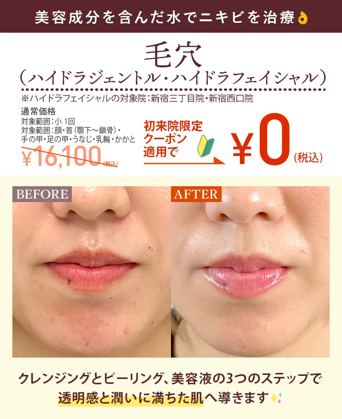 毛穴（ハイドラジェントル・ハイドラフェイシャル）