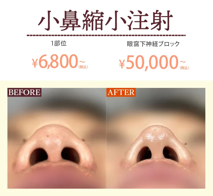 小鼻縮小注射