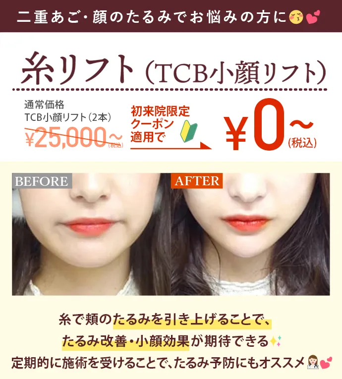 糸リフト（TCB小顔リフト）