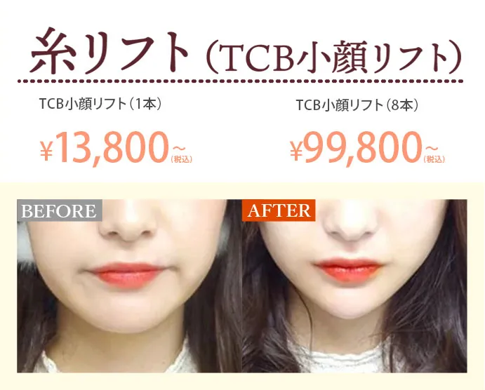糸リフト（TCB小顔リフト）