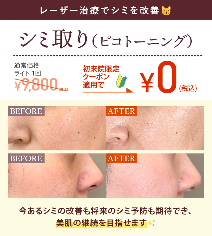 シミ取り（ピコトーニング）