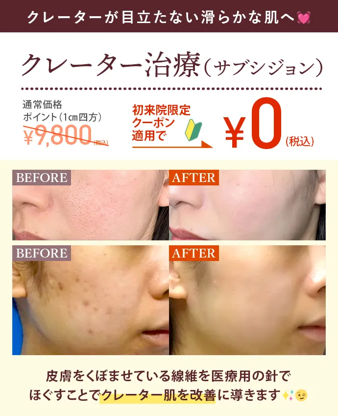 クレーター治療（サブシジョン）