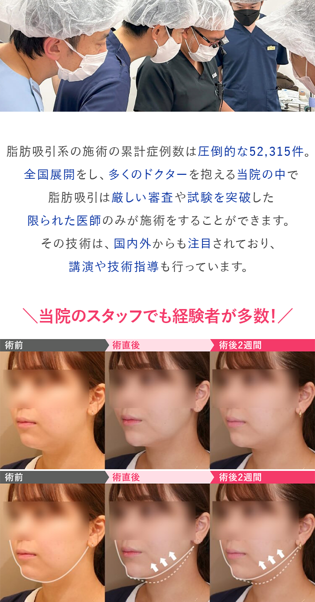 脂肪吸引系の施術の累計症例数は～