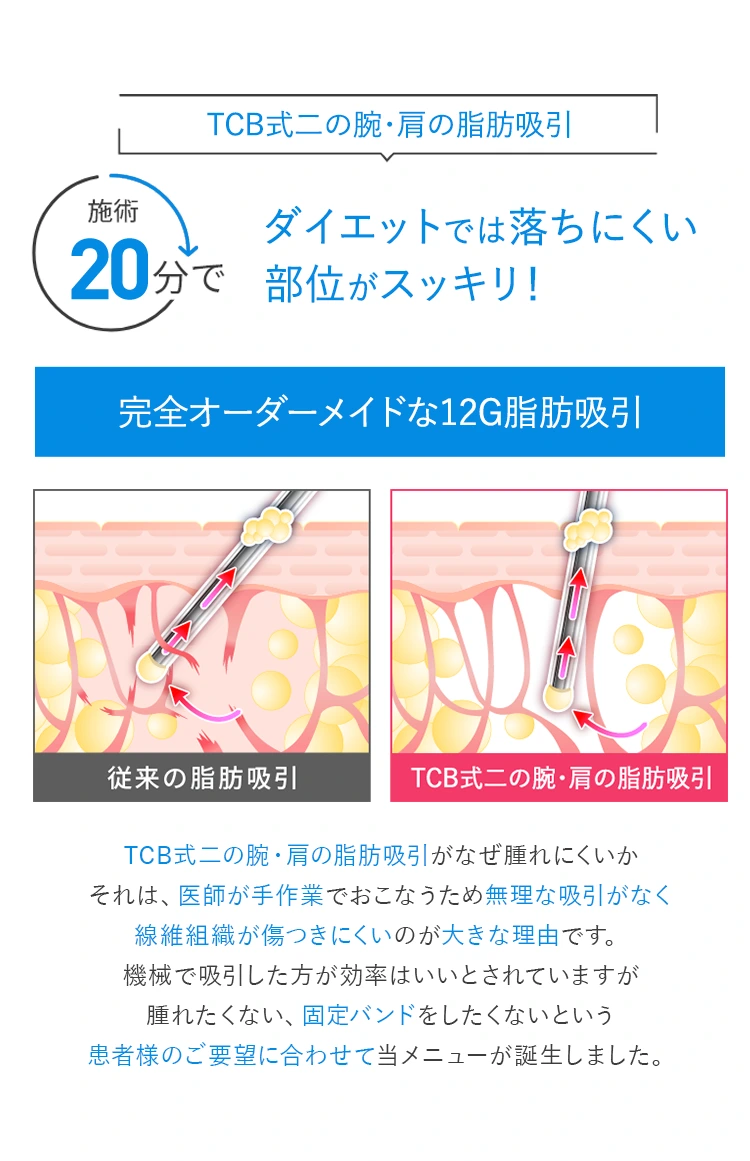 TCB式二の腕・肩の脂肪吸引｜完全オーダーメイドな12G脂肪吸引