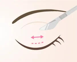 ミニ切開