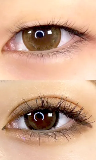 二重術経過写真