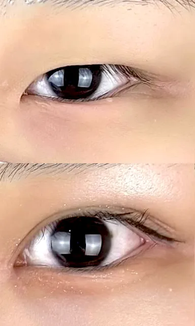 二重術経過写真