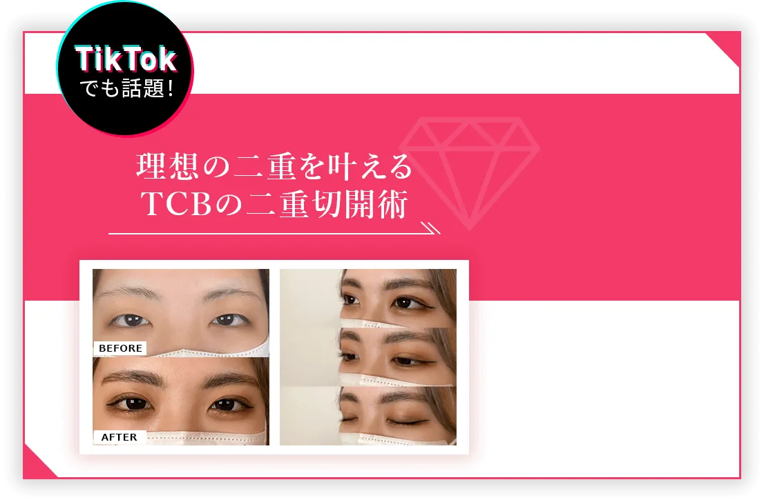 理想の二重を叶えるTCBの二重切開術