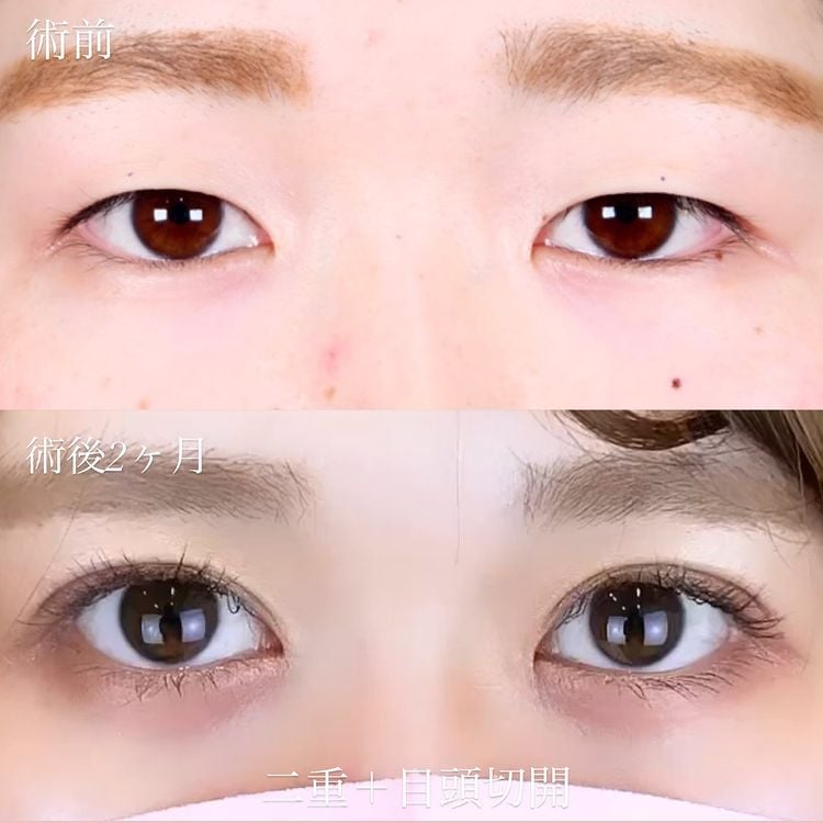 二重術経過写真