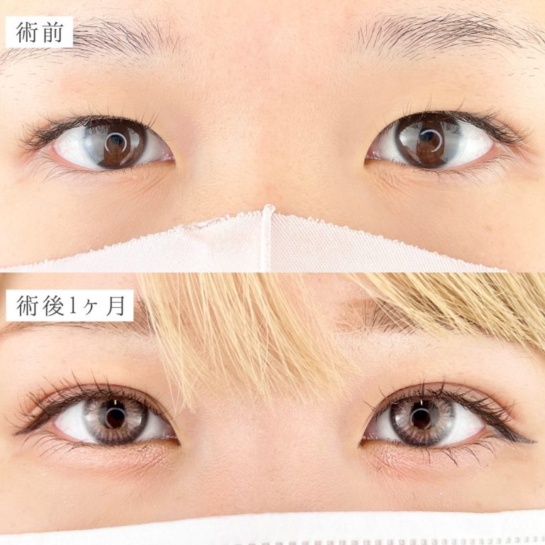 二重術経過写真