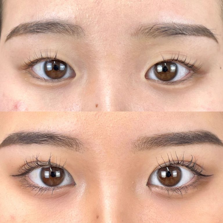 二重術経過写真