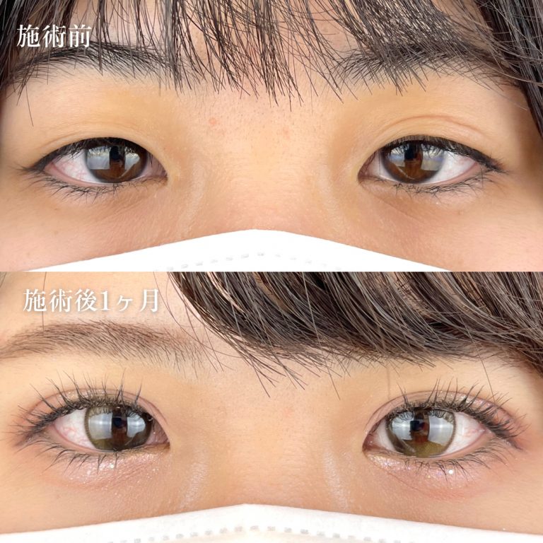 二重術経過写真