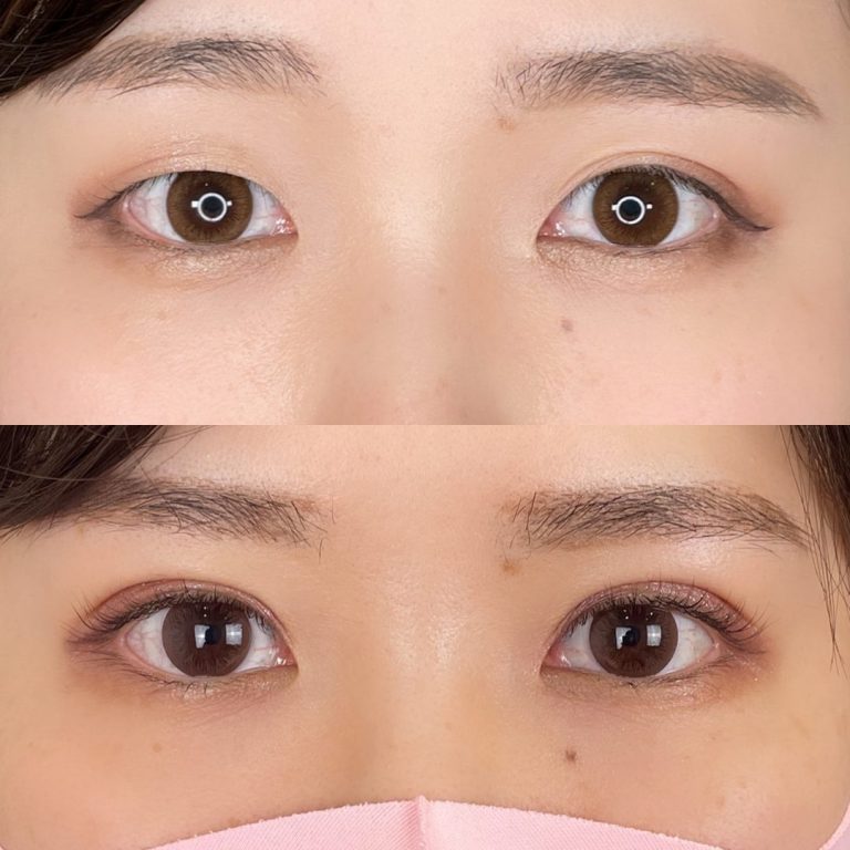 二重術経過写真