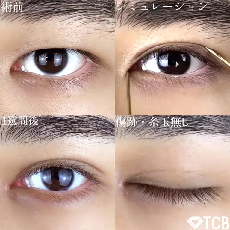 目頭切開の症例写真