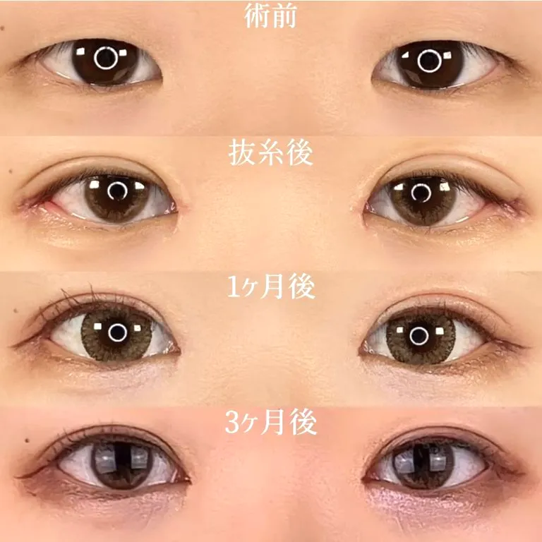 目尻切開の症例写真