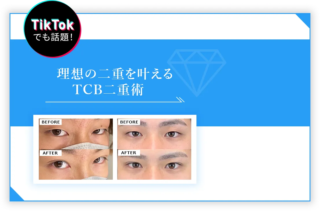 TikTokでも話題！理想の二重を叶えるTCB二重術