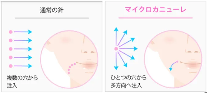 従来の針とマイクロカニューレ比較