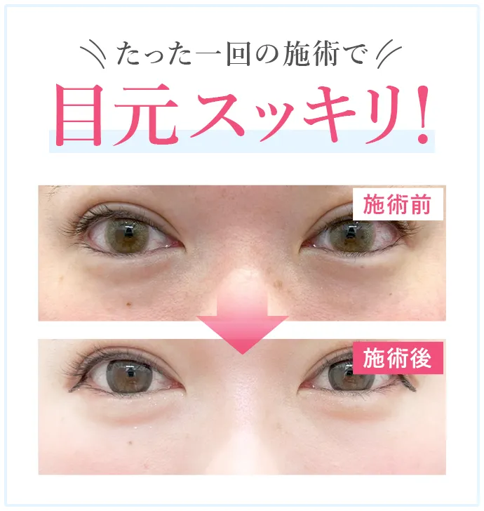たった1回の施術で目元スッキリ!