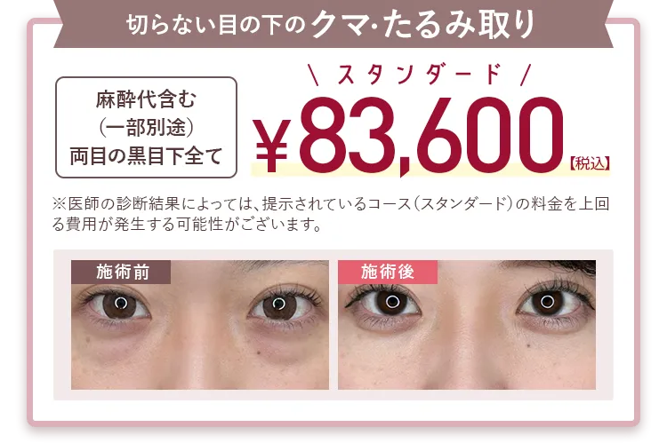 切らない目の下のクマ・たるみ取り 53,600円（税込）～