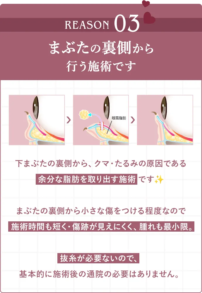 REASON03 まぶたの裏側から施術を行う施術です