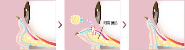 施術イメージ図