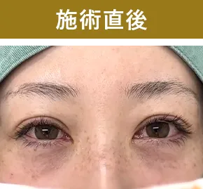 施術直後