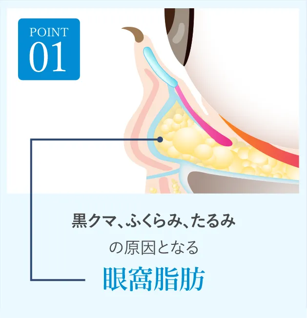 POINT01 黒クマ、ふくらみ、たるみの原因となる眼窩脂肪